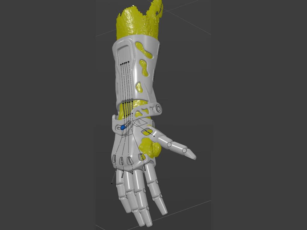 Modelul 3D al protezei, poziționat pe scanarea 3D a mâinii pacientului